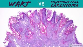 Wart vs Squamous Cell Carcinoma Dermpath Pathology Dermatology Verruca Seborrheic Keratosis SCC [upl. by Emaj]