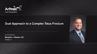 Dual Approach to a Complex Talus Fracture [upl. by Nnaeed475]