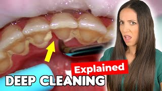 Dental Hygienist Explains Deep Cleaning Procedure [upl. by Ecinereb]