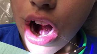 Functional frenuloplasty updated technique with lingual palatal suction [upl. by Harriman]