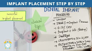 dental implant procedure [upl. by Otes]