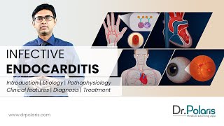 INFECTIVE ENDOCARDITIS  Etiology Pathophysiology Clinical Features Management  Animated [upl. by Dalston]