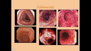 Dermatomyositis Polymyositis Inclusion Body Myositis STEP NCLEX COMLEX [upl. by Hernandez69]