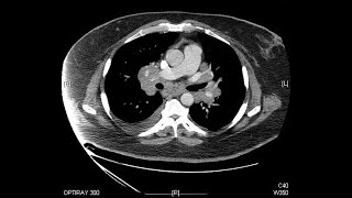 Imaging of Mediastinum Radiological Anatomy  Dr Avni Skandhan MD [upl. by Hsitirb803]