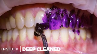 How Teeth Are Professionally Deep Cleaned  Deep Cleaned [upl. by Heidt]