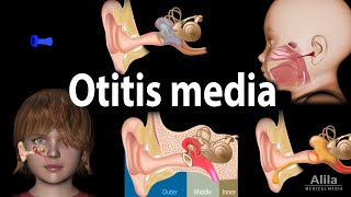 Otitis Media Anatomy Pathophysiology Risk Factors Types of OM Symptoms and Treatment Animation [upl. by Nahtnaoj]