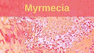 Deep Palmoplantar Wart Myrmecia  Pathology mini tutorial [upl. by Nikolas]