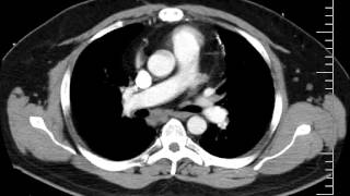 Mediastinal anatomy and nodal stations on CT [upl. by Akerue659]