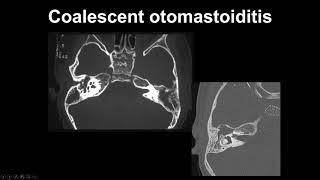 Otomastoiditis Summary  Middle Ear MRI  MRI Online [upl. by Aicened]