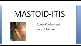 ENT Mastoiditis What is Mastoid Inflammation Infection Acute Coalescent Pain behind ear [upl. by Lydie796]