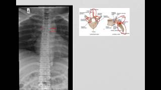 Thoracic Spine AP and Lateral [upl. by Nitsid116]