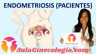 ENDOMETRIOSIS PACIENTES Síntomas diagnóstico tratamiento fertilidad Ginecología y Obstetricia [upl. by Asp]