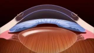 Cornea transplant [upl. by Nahum]