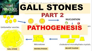 Gallstones  Cholelithiasis Symptoms Causes Diagnosis and Treatment [upl. by Cozza7]