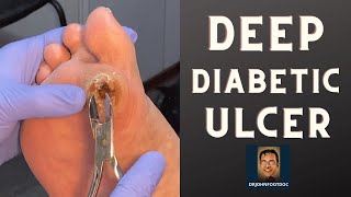 DEEP Diabetic Foot Ulcer podiatristfoot and ankle specialist treats a foot ulcer [upl. by Sukey450]