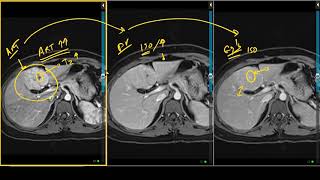 What Is Hyperplasia Hyperplasia Meaning Explained [upl. by Nyladnor]