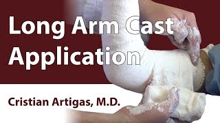 Long Arm Cast Application [upl. by Nyrem]