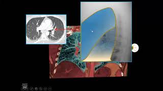 Anatomy of MEDIASTINUM  Dr Yusuf [upl. by Anaiq273]