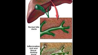 Primary Sclerosing Cholangitis [upl. by Lorilyn]