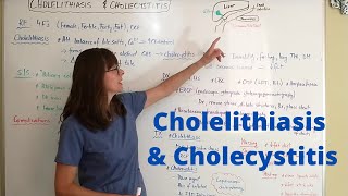 Cholelithiasis amp Cholecystitis [upl. by Idyh502]