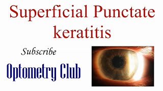 Superficial Punctate Keratitis Introduction Diagnosis and Treatment [upl. by Akinna]